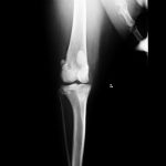 immagine radiografica Radiografia del ginocchio per il controllo della displasia della rotula