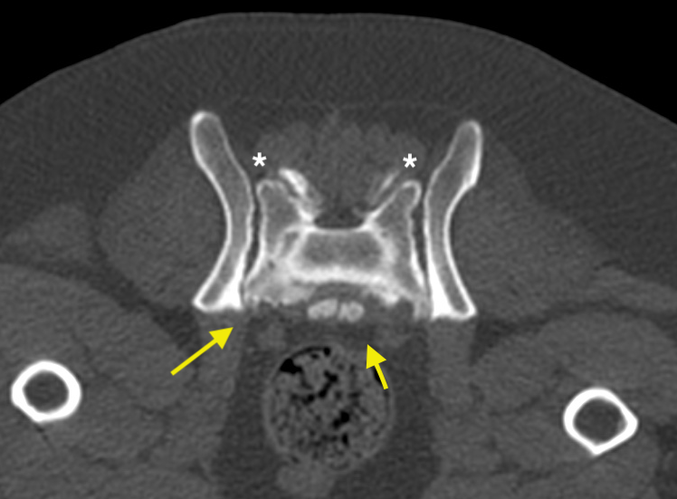 Scansione Tac in un paziente che presenta una grave calcificazione del disco inter vertebrale  (freccia piccola) e un riduzione dei formalina di passaggio del nervo nella zona articolare destra e sinistra  ( asterisco)
