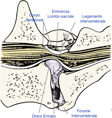 Immagine di come si sviluppa la Stenosi Lombo-sacrale degenerativa
