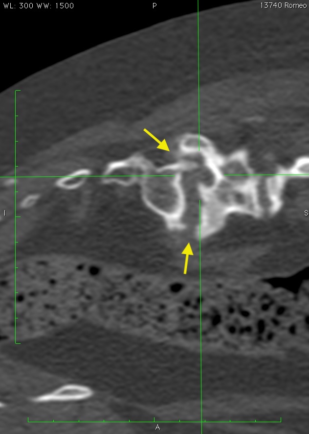 Tac di una stenosi L.S. con evidente restringimento dei forami di passaggio dei rami nervosi con calcificazioni
