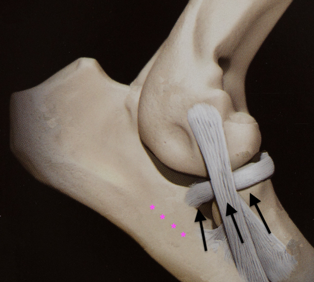 Modello anatomico esplicativo delle forze compressive che agiscono nell'articolazione del gomito. Le frecce indicano la direzione della compressione . Gli asterischi la zona subcondrale dove avvengono le micro fratture.