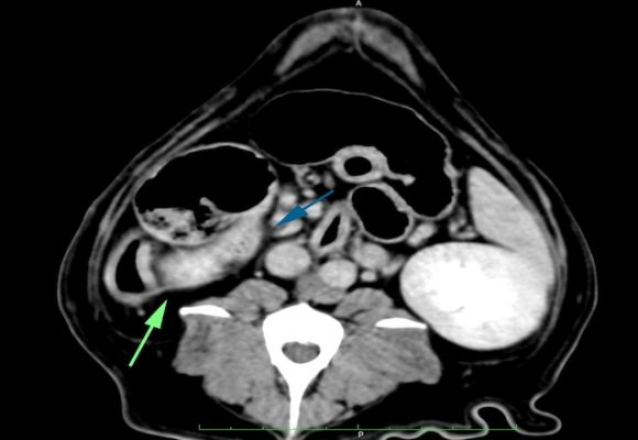 Ruolo della TAC nella diagnosi dell’ Insulinoma  canino.  La storia di Paulina.