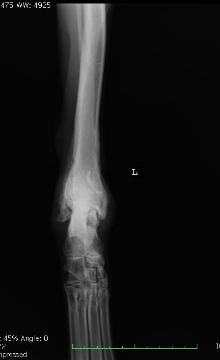 Radiografia dopo 3 mesi e rimozione dei mezzi di sintesi