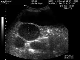 Immagine ecografiaca delle corna uterine di una cagna affetta da Piometra