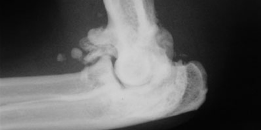 Ecco un esempio di Osteoartrosi ad un gomito
