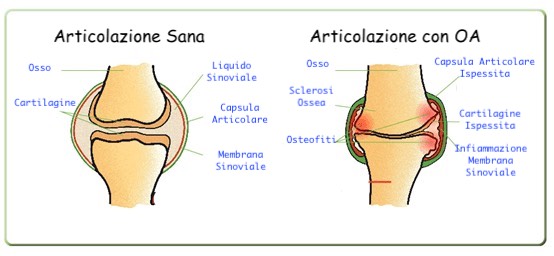 Esempio di una evoluzione di Osteoartrite partendo da una articolazione sana