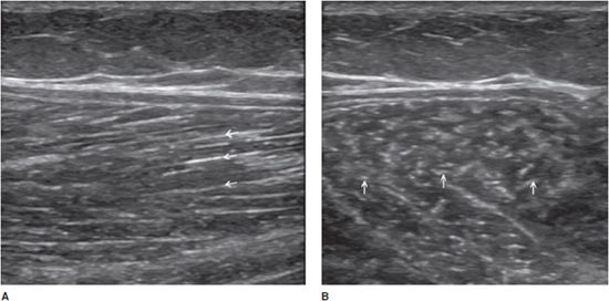 Nel riquadro A il muscolo normale, mentre nel riquadro B le aree di lesione muscolare indicate dalle frecce nella miopatia del muscolo gracile e semitendinoso