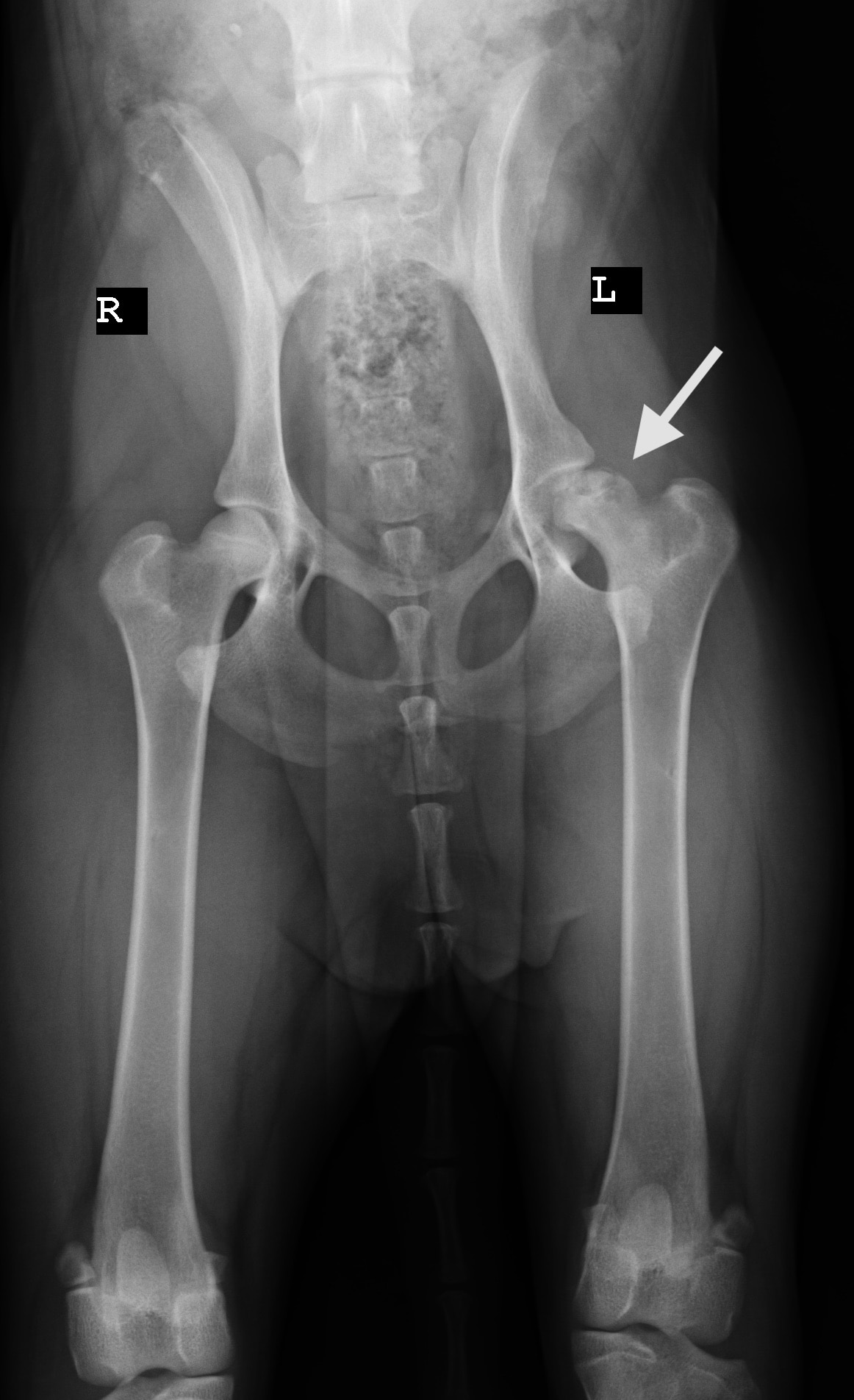 Necrosi Avascolare Testa del Femore o Malattia di Legg-Calve-Perthes