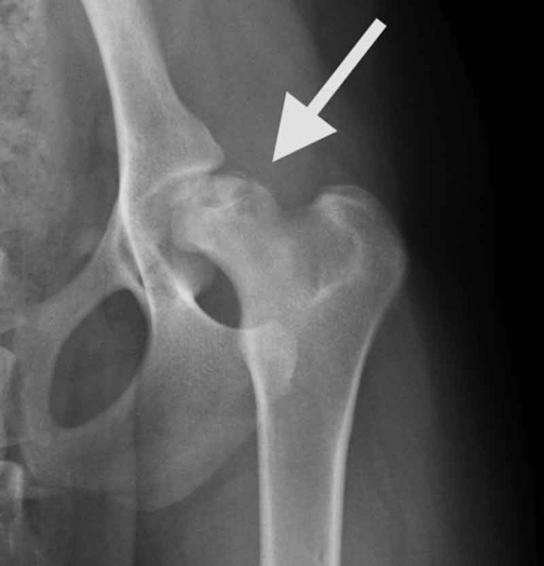 Necrosi Avascolare Testa del Femore o Malattia di LeggCalvePerthes